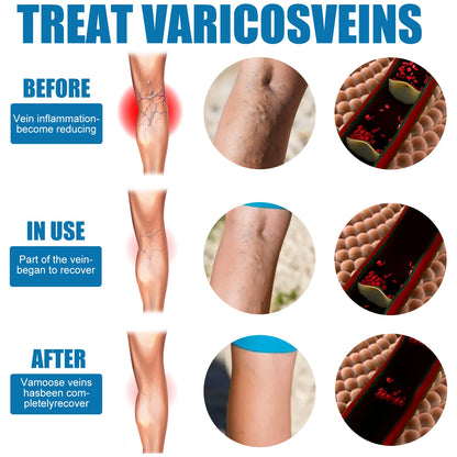 Solva™ Varicose Vein Spray