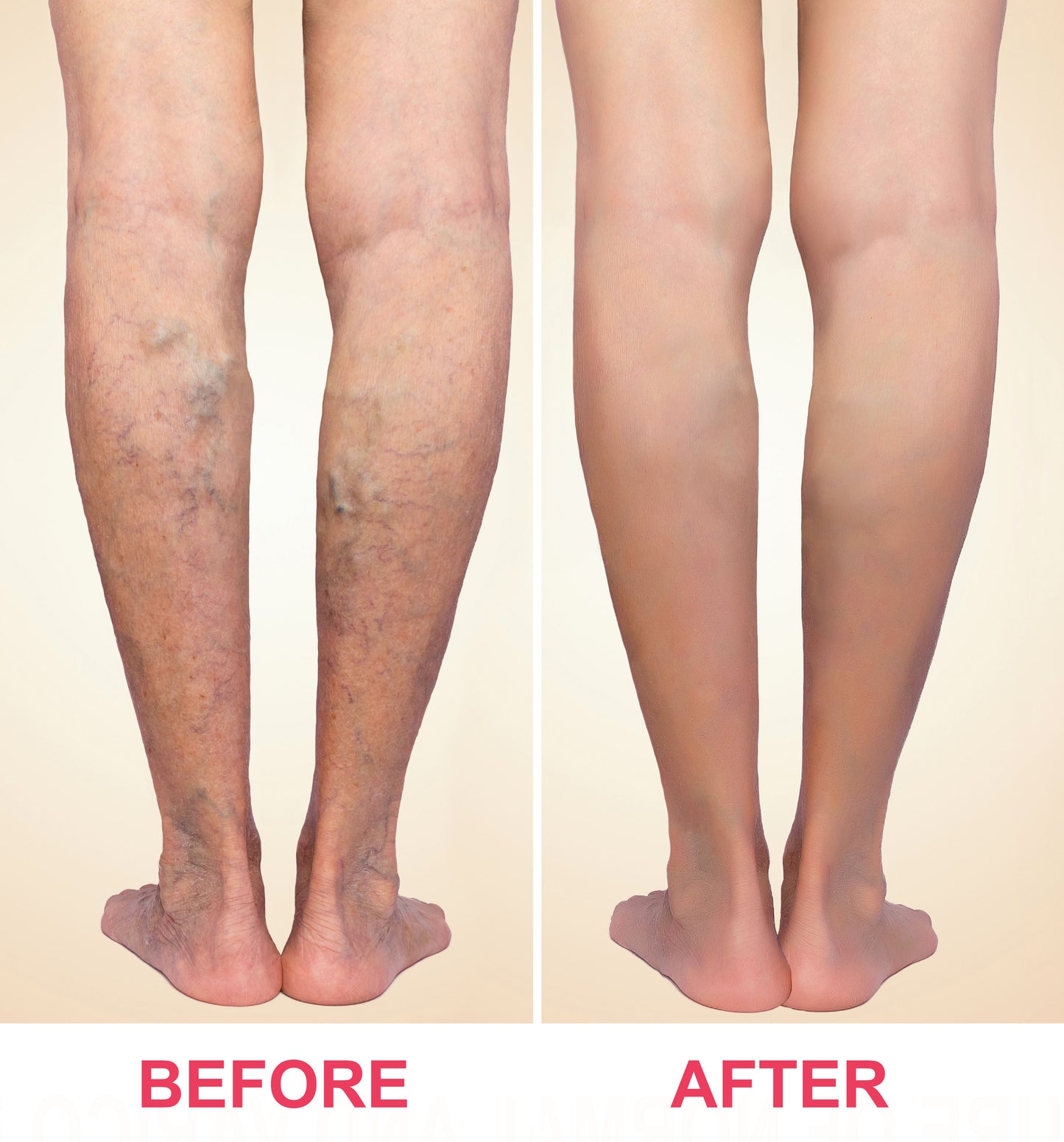 Solva™ Varicose Vein Spray