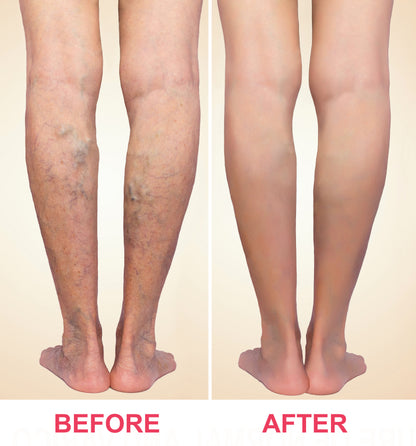 Solva™ Varicose Vein Spray