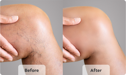 Solva™ Varicose Vein Spray